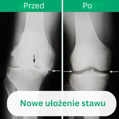 OrthoKnee™ – Długotrwała ulga w przypadku artretyzmu i bólu stawów